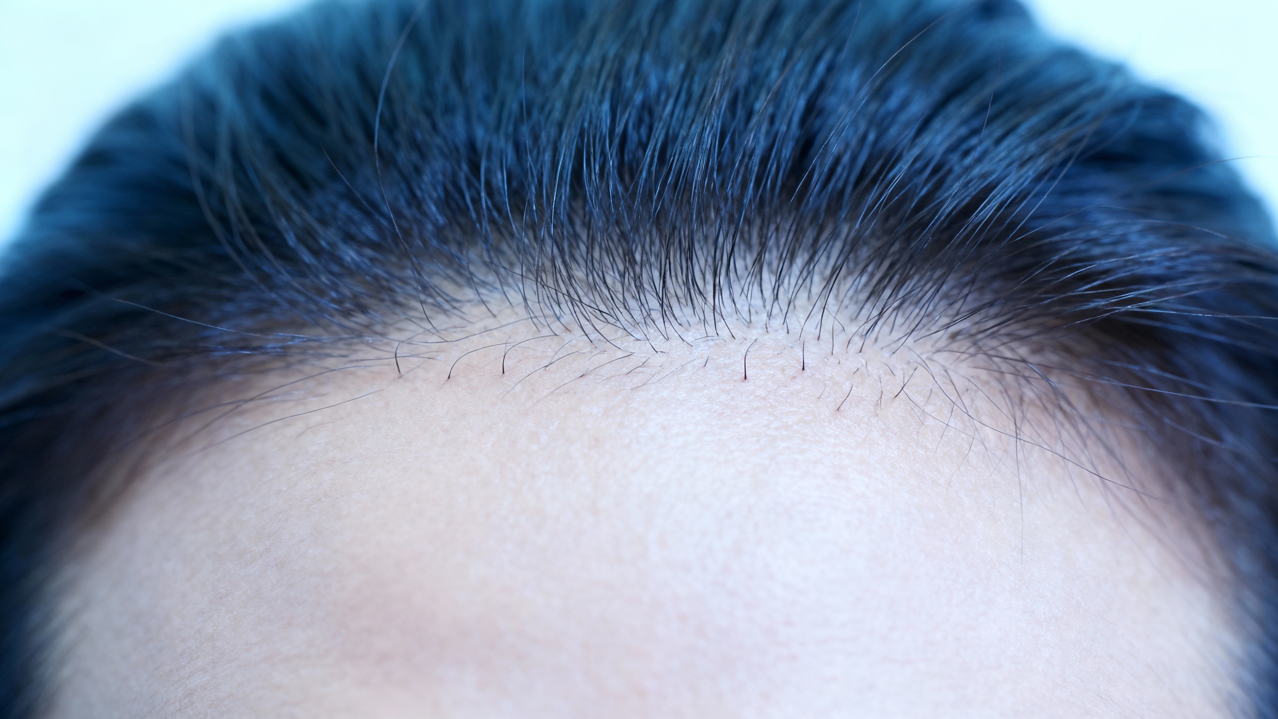 Featured image for Say Goodbye to Scalp Flakes: Effective Strategies for Coping with Seborrheic Dermatitis
