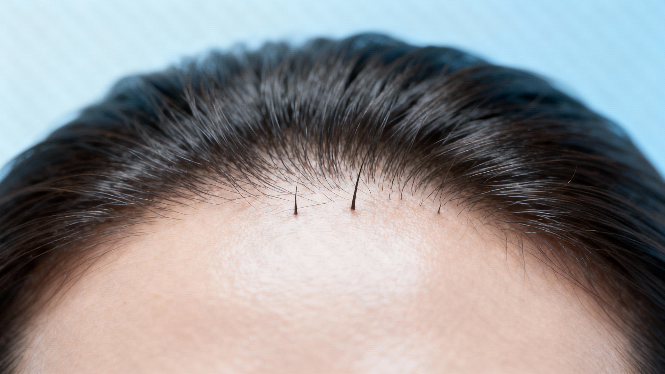 Featured image for Unveiling the Secrets: Effective Seborrheic Dermatitis Management Strategies