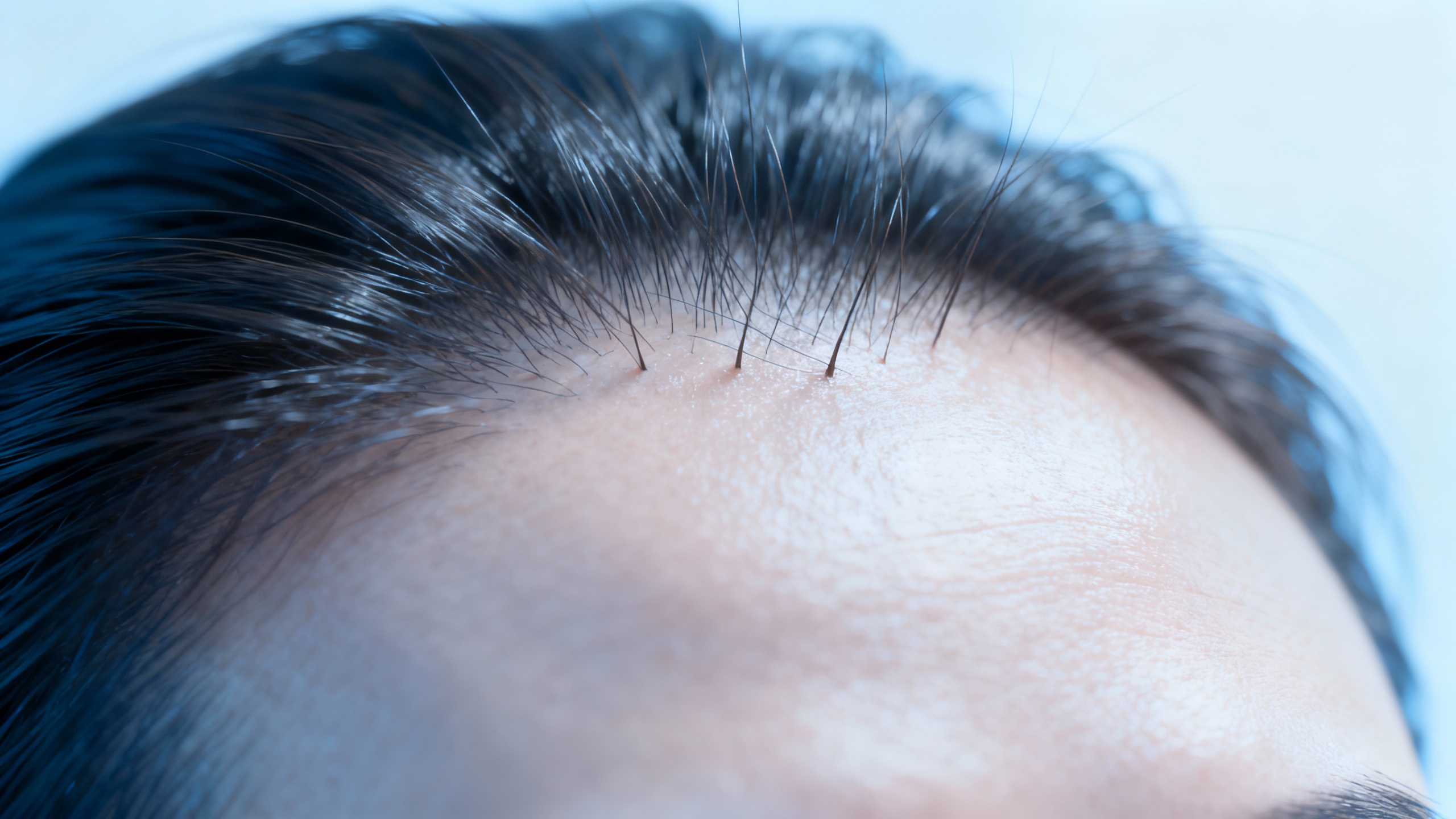 Featured image for Banish the Flakes: Effective Seborrheic Dermatitis Relief Strategies